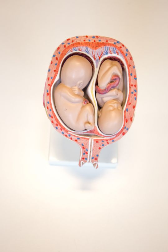 Anatomisch model tweelingzwangerschap